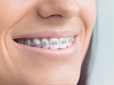 Braces for kids glendale az