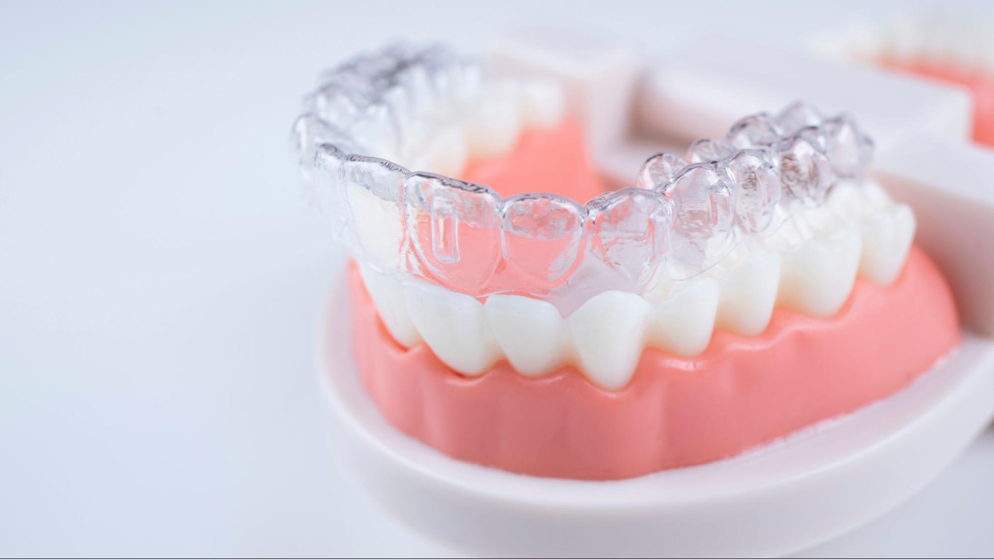 How Clear Aligner Technology Works